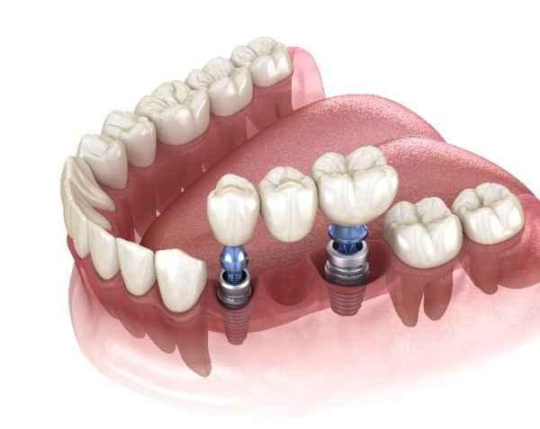 dental implants Eastleigh