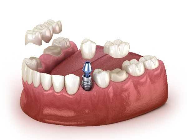 dental implant Sheffield