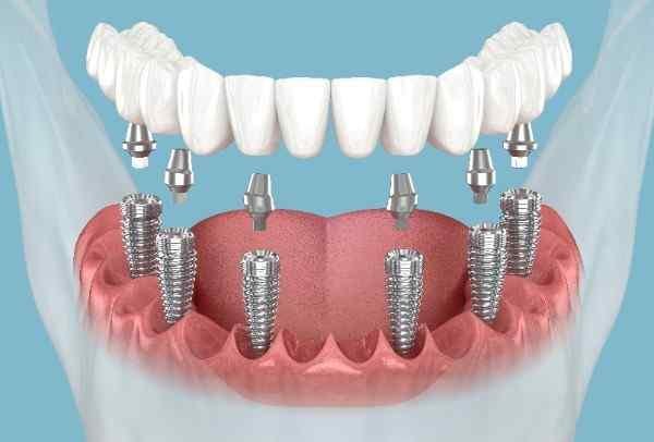 Dental Implant Northampton